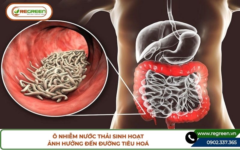 Bệnh nhân tiêu chảy cấp do nguồn nước ô nhiễm nước thải sinh hoạt.