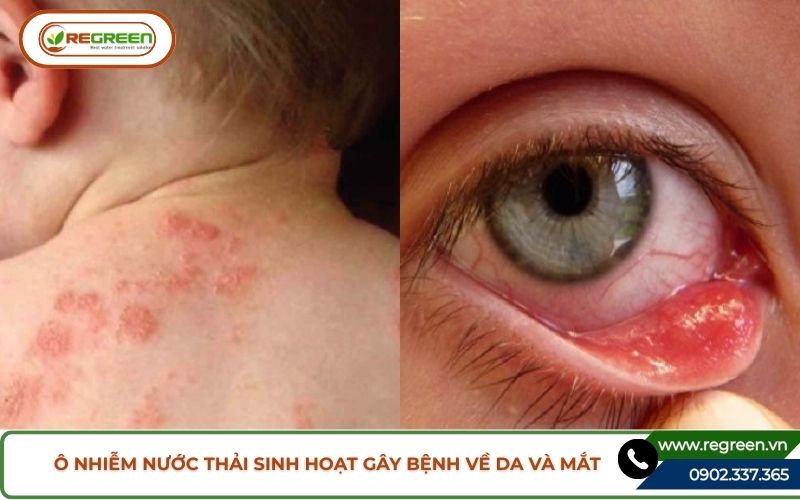 Mắc bệnh ngoài da và mắt do ô nhiễm nước thải sinh hoạt.